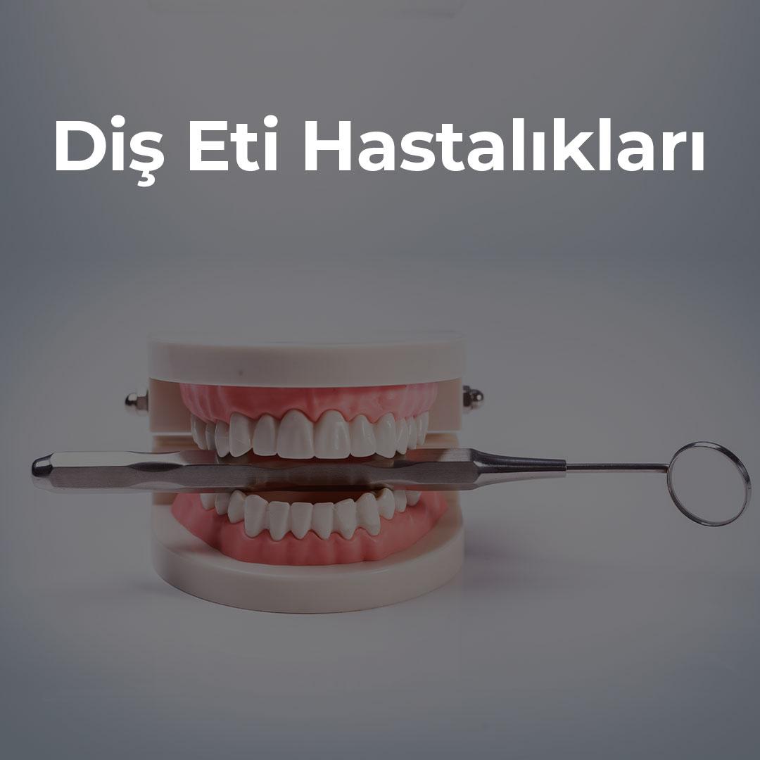 Diş Eti Hastalıkları