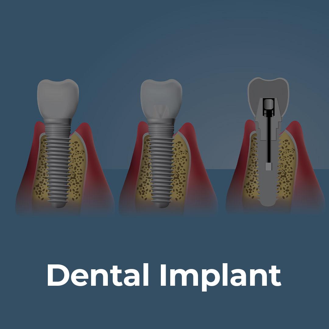 Dental Implant